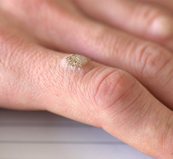 Wart removal