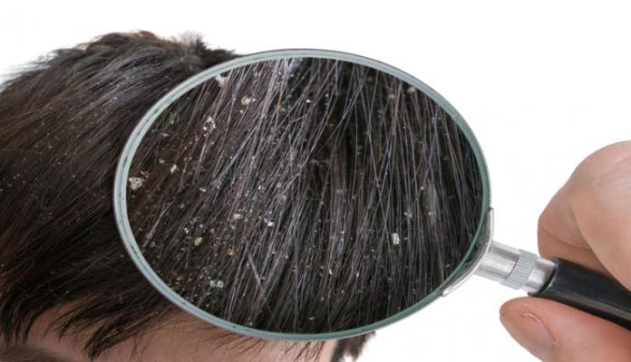 Dandruff treatment