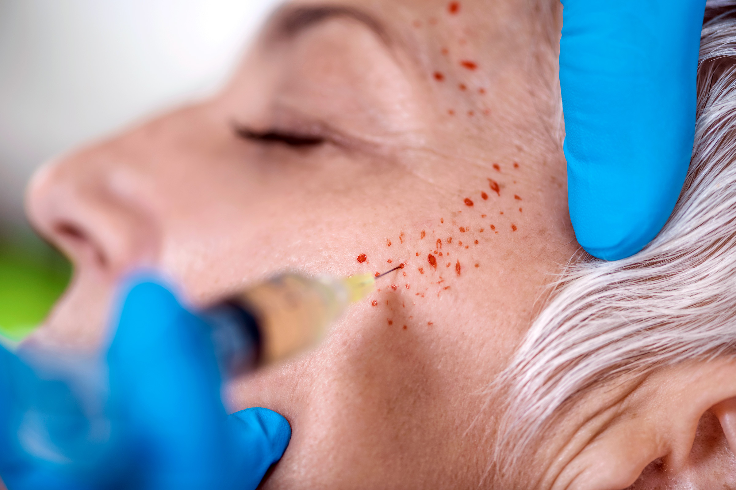Vampire facial