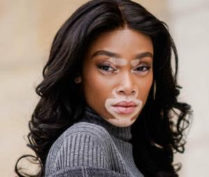 Vitiligo surgery